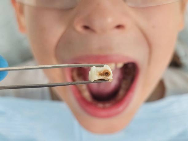 Best Dentist for Tooth Abscess  in Markesan, WI